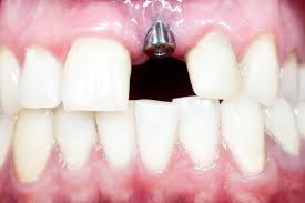 Image result for dental implant