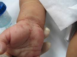 Essa doença, que é bastante. Escabiose Disturbios Dermatologicos Manuais Msd Edicao Para Profissionais