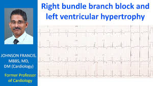 Image result for Left Ventricular Hypertrophy