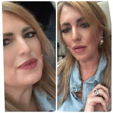 Glad i listened to the ladies @ Affordatox & went with a full syringe of  lip filler!!! Cannot wait to see how they look after they go thru the  healing process!! I'll