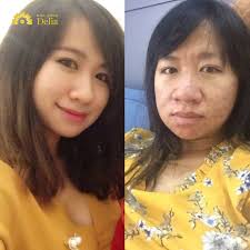 Dấu hiệu nhận biết có thai qua khuôn mặt, điều gì cần chú ý