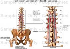 There is one disc between each pair of vertebrae. Post Fixation Condition Of T12 And L1 Vertebrae Medical Illustration Human Anatomy Drawing Anatomy Illustration