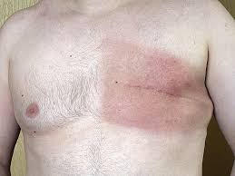 Male breast cancer (male breast neoplasm) is a rare cancer in males that originates from the breast. Male Breast Cancer How Long You Live Depends On This Steemkr