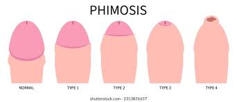 Image result for Phimosis