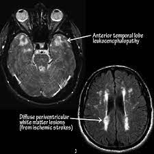 maladie du cadasil francais nouveau aujourd hui