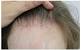Bumps On Hairline On Back Of Neck