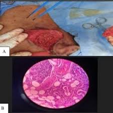 Image result for Sialoadenitis