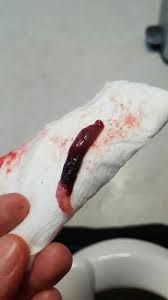 Miscarriage blood clots pictures 5 weeks. 5 Weeks Passing Clots Glow Community