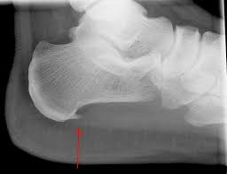 Maybe you would like to learn more about one of these? Exostosis Causes Types And Treatment
