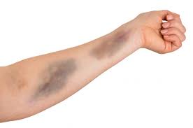 A bruise, or contusion, appears on the skin due to trauma. Symptoms Causes And Risks Of Thrombocytopenia Facty Health
