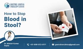 Image result for Blood in stool