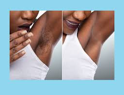 Like traditional waxing, sugaring removes hair from the root but does not kill the hair at its root. Does Sugaring Remove Hair Permanently Hair Dye Removal Skin Care Wrinkles Face Products Skincare