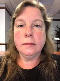 Had my implant surgery yesterday. Was in moderate discomfort in the neck.  By the time we got home- a 5 hr drive, I was very swollen which I expected  and pain a