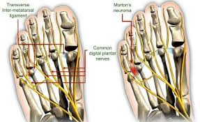 Neuroma in bilateral upper limb amputation. Safety Shoes Against Morton S Neuroma Safety Shoes Today