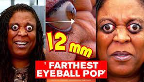 Man breaks world record for farthest eyeball pop