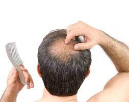 Like telogen effluvium, alopecia areata can lead to hair that looks thin or bald spots. More People Are Losing Hair During Coronavirus Pandemic Miami Herald