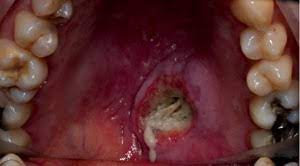 The vast majority of mouth cancers begin in the squamous cells. Mouth Cancer Acute Necrotising Sialometaplasia British Dental Journal