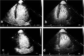 Image result for Left Ventricular Noncompaction