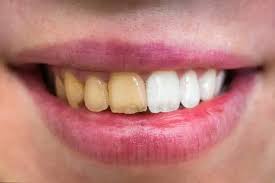 Image result for Tooth Discoloration