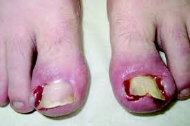 Image result for Paronychia feet