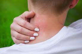 Maybe you would like to learn more about one of these? Mengenali Penyebab Bintik Merah Pada Kulit Disertai Gatal Alodokter