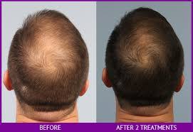 The highest quality scalp micro pigmentation at if you're searching for quality hair loss treatment in los angeles or the surrounding area, downey hair loss solutions is here to help. A Cell Add On For Prp Hair Loss Treatments In Los Angeles