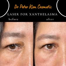 Image result for xanthelasma of eyelid