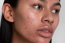 Image result for Hyperpigmentation