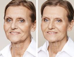 Jowl Tightening Nefertiti Lift Treatment Neck Fillers Milo Clinic