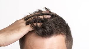 For best results, massage the shampoo into your hair and scalp, leaving it on for one to five minutes before rinsing. Causes And Remedies For Hail Fall In Men Nisargalaya