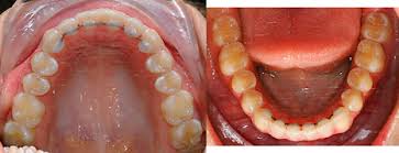 Image result for Dentition