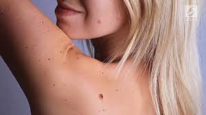 Bagaimana klinik tersebut membuang tahi lalat? Cara Menghilangkan Tahi Lalat Dengan Alami Cepat Dan Mudah Health Liputan6 Com