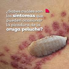 Secretaría de Salud Jalisco on X: La prevención puede salvarte de sufrir  una picadura de oruga peluche. ¡Reconócela! t.coeWhrZxCXbs  X
