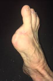 Image result for toe amputation