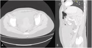 An incidental finding in a case of sigmoid diverticular disease. Benign Multicystic Peritoneal Mesothelioma Bmpm Presenting With Ambiguous Symptoms A Rare Case Report Sciencedirect