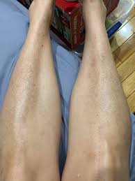 Image result for Pigment stains on the shin
