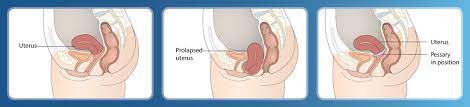 You may be able to take out, clean, and reinsert your pessary yourself. A Nursing Protocol For Vaginal Ring Pessary Change
