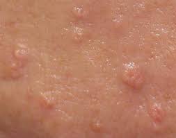 Image result for Sebaceous Gland
