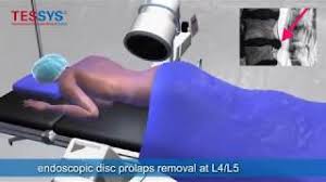 De multe ori, se recomanda operatia ca solutie pentru hernia de disc, desi cei mai multi oameni sunt foarte reticenti cand vine vorba de chirurgie. Operatie Hernie De Disc Lombara Animatie Youtube