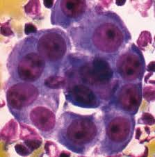 Consecutive patients with undiagnosed pleural effusions who underwent. Malignant And Borderline Mesothelial Tumors Of The Pleura Clinical Gate