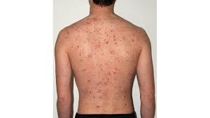 Some years the flu season can be much more aggressive than others. Shingles In Young Adults Why It S Possible Symptoms More