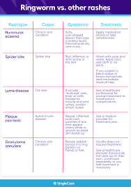 There are numerous causes for hair loss in dogs. Ringworm In Kids The Parent S Guide To Symptoms And Treatment