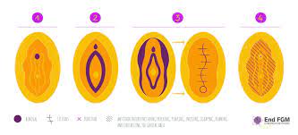 It is routinely practised by obscure islamic sects or people with links to african tribes who have termed it. What Is Fgm End Fgm