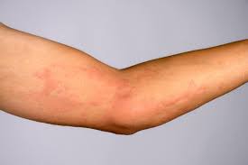 Image result for dermatitis contacta allergica