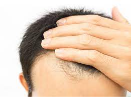Salkey, m.d., associate professor of dermatology and director of the. Hair Loss Pariser Dermatology