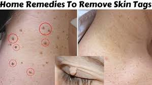 Today I Am Sharing With You Top 5 Home Remedies To Remove Skin Tags Easily At Home Skin Tags Appear In A Mul Skin Tag Removal Skin Tags Home Remedies Skin Tag