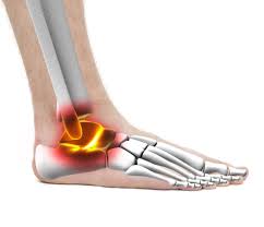 Sinus Tarsi Syndrome In Runners Doc Sinus Tarsi Syndrome In Runners