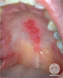 7 westferry circus ● canary wharf ●. Dermis Systemic Lupus Erythematosus Image Krankheit Ernahrung Behandlung