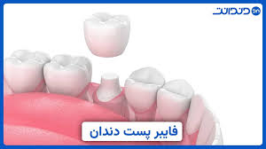 فایبر پست دندانپزشکی | تقویت ساختار دندان پس از عصب کشی