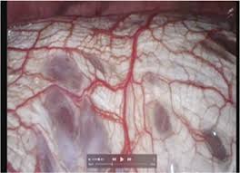 Endometriosis is typically a progressive condition, meaning it can get worse over time (29). Endometriosis A Complex Disease The Center For Endometriosis Care